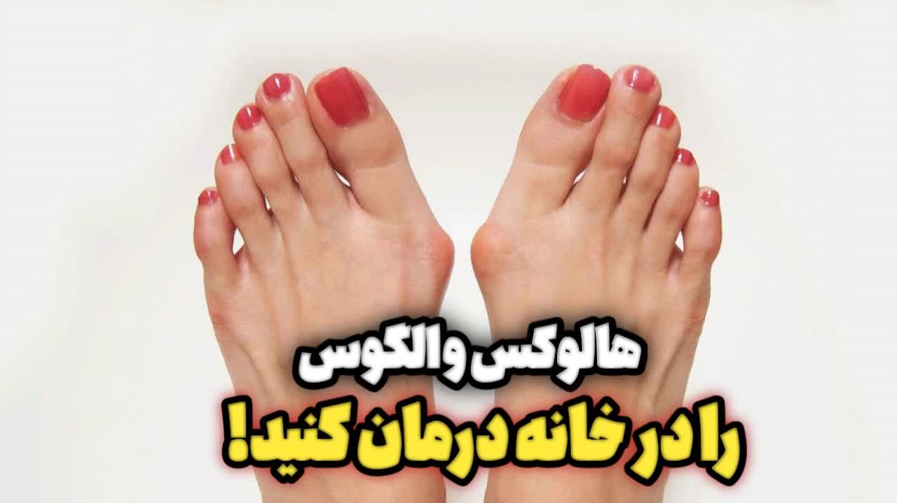 درمان بیماری هالوکس والگوس در خانه!! درمان بیماری هالوکس والگوس در خانه!!