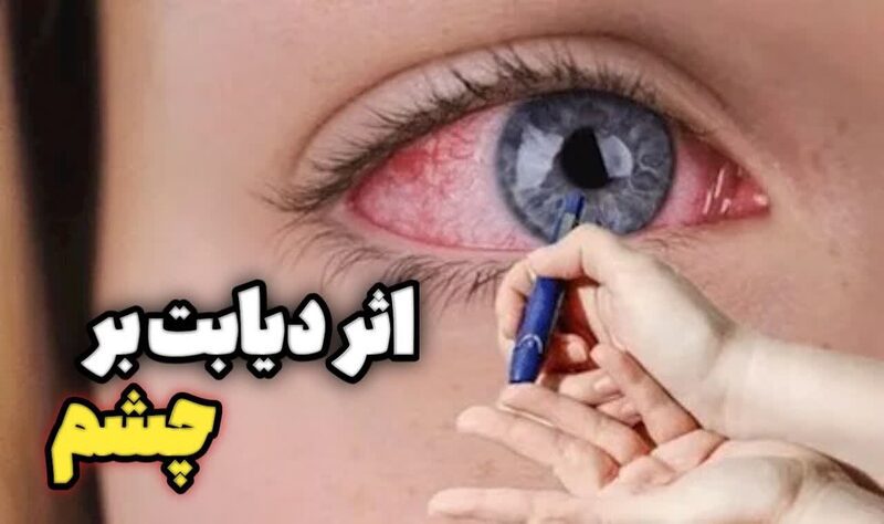 اثرات دیابت بر چشم اثرات دیابت بر چشم