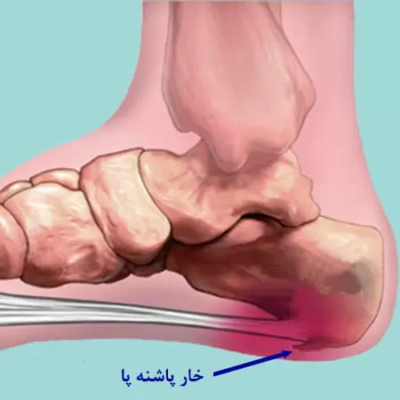 خار پاشنه چیست و چه علائمی دارد؟