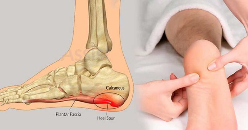 خار پاشنه چیست و چه علائمی دارد؟