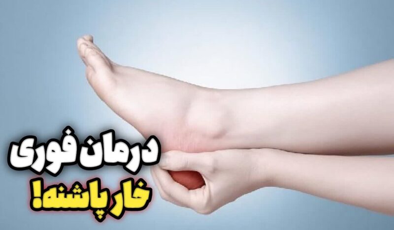 خار پاشنه چیست و چه علائمی دارد؟ خار پاشنه چیست و چه علائمی دارد؟